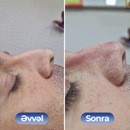 Kosmetoloq Dr. Şural Həbibov bir çox kosmetoloji prosedurları yüksək səviyyədə icra edir