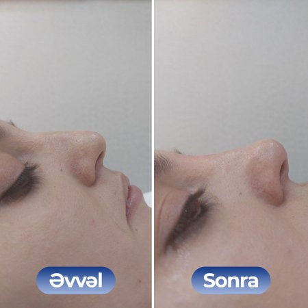 Kosmetoloq Dr. Şural Həbibov bir çox kosmetoloji prosedurları yüksək səviyyədə icra edir