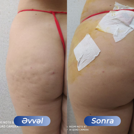 Kosmetoloq Dr. Şural Həbibov bir çox kosmetoloji prosedurları yüksək səviyyədə icra edir