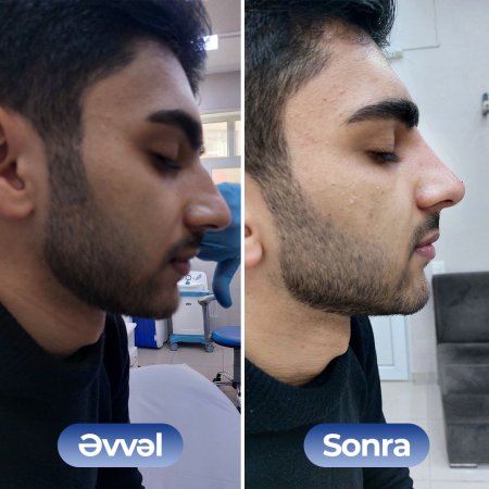 Kosmetoloq Dr. Şural Həbibov bir çox kosmetoloji prosedurları yüksək səviyyədə icra edir