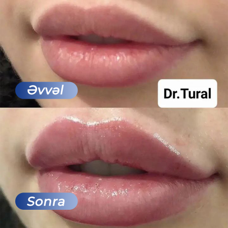 Kosmetoloq Dr. Şural Həbibov bir çox kosmetoloji prosedurları yüksək səviyyədə icra edir