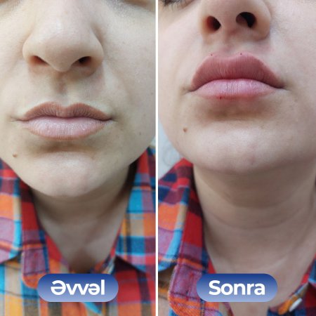 Kosmetoloq Dr. Şural Həbibov bir çox kosmetoloji prosedurları yüksək səviyyədə icra edir