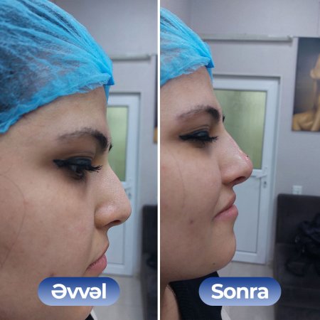 Kosmetoloq Dr. Şural Həbibov bir çox kosmetoloji prosedurları yüksək səviyyədə icra edir