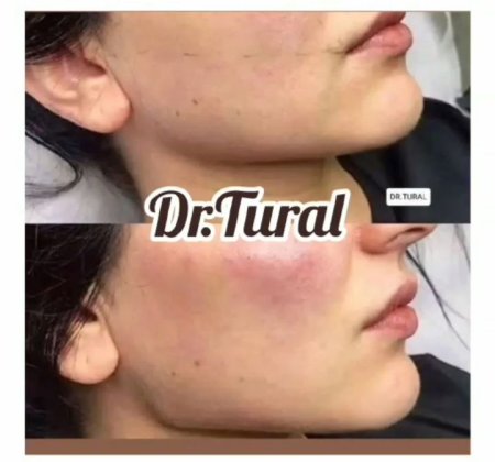 Kosmetoloq Dr. Şural Həbibov bir çox kosmetoloji prosedurları yüksək səviyyədə icra edir