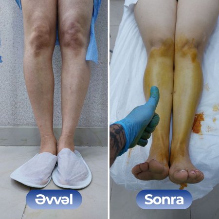 Kosmetoloq Dr. Şural Həbibov bir çox kosmetoloji prosedurları yüksək səviyyədə icra edir