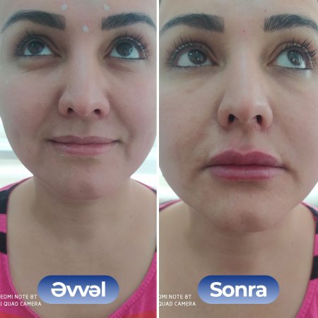 Kosmetoloq Dr. Şural Həbibov bir çox kosmetoloji prosedurları yüksək səviyyədə icra edir